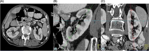 Figure 1. A 79-year-old female patient. Axial computed tomography (CT) image (A). Sagittal oblique (B) and coronal oblique (C) images reformatted according to pole-to-pole length (R1) of left kidney. R1 was measured as 101 mm.