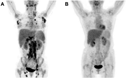 Figure 5 A patient with interim18F-FDG PET/CT showed increased 18F-FDG uptake in the neck, axilla, mediastinum, abdominal and pelvis. D-5PS and IHP criteria were considered positive for patient, and the patient experienced relapse after 7 months of follow-up. A patient with an interim18F-FDG PET/CT D-5PS (score 1) and negative IHP criteria did not show progression and survived at the end of the 28-month follow-up period (B).