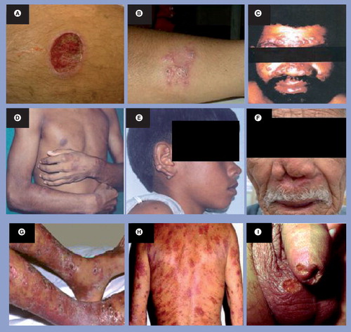 Figure 1. Clinical forms of tegumentary leishmaniasis.(A) Localized cutaneous leishmaniasis presenting single ulcer on the leg (reprinted with permission from Luiza K Oyafuso, Instituto de Infectologia Emilio Ribas de São Paulo, Brazil). (B) Leishmaniasis recidiva cutis presenting papules and vesicles around the healed lesion of cutaneous leishmaniasis on the leg (reprinted with permission from Jackson ML Costa, Universidade Federal do Maranhão, Brazil). (C) Disseminated cutaneous leishmaniasis presenting numerous ulcers on the face (reprinted with permission from Jackson ML Costa). (D) Diffuse cutaneous leishmaniasis presenting infiltrated nodules on the arms and thorax (reprinted with permission from Fernando T Silveira, Universidade Federal do Pará-Brazil, Brazil). (E) Diffuse cutaneous leishmaniasis presenting infiltrated nodules on the ear (reprinted with permission from Fernando T Silveira). (F) Mucosal leishmaniasis with destructive lesion in the nose (reprinted with permission from Luiza K Oyafuso). (G) Atypical cutaneous leishmaniasis in a HIV-infected patient presenting multiple ulcers on the legs and feet. (H) Atypical cutaneous leishmaniasis in HIV-infected patient presenting erythematous plaques on the back, and (I) atypical cutaneous leishmaniasis in a HIV-infected patient presenting ulcers on the scrotum and penis.Images G, H and I reproduced from Citation[28] with permission from Wiley-Blackwell.