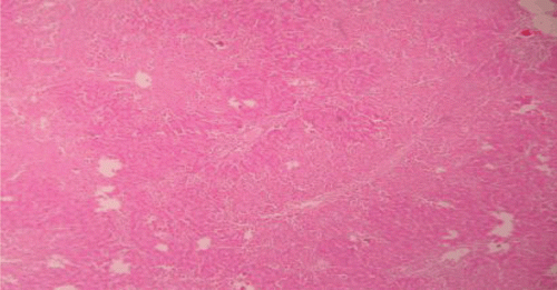 Figure 4.  Liver section of PdAE (200 mg/kg) and paracetamol showing less fatty changes, mild necrosis, degeneration and little infiltration of lymphocytes.
