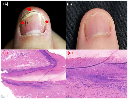 Figure 1. The clinical manifestations of the patient and histopathology of the nail biopsy: (A) the appearance of right fingernail before treatment, we can see typical sings of longitudinal ridging, splitting (star), onychoschizia, onycholysis, subungual hyperkeratosis (arrow) and splinter hemorrhage (triangle). (B) Complete clearance after 6 months of treatment with baricitinib, 4 mg, daily. (C–D) The biopsy specimen showing a band of lymphocytes infiltrate around the matrix and the eponychium, with focal hyperkeratosis, hypergranulosis, vacuolar basal cell degeneration and lack of spongiosis. Hematoxylin-eosin, original magnification ×50 and ×200, respectively.