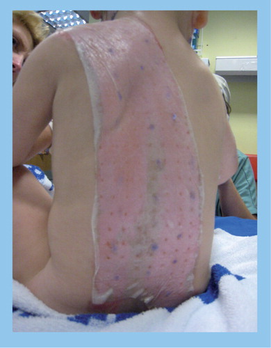 Figure 1. Utilization of a biologically derived dressing, Biobrane™, in the treatment of an extensive scald burn on an 18-month-old child.