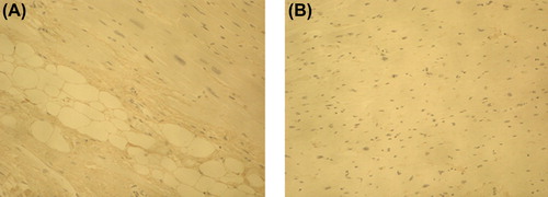 Figure 3. Immunohistochemical staining of ICTP in myocardium of idiopathic fibrosis case (A) and in control case (B). Magnification × 200. ICTP reflecting collagen type I degradation did not differ between the IMF case and control myocardium.