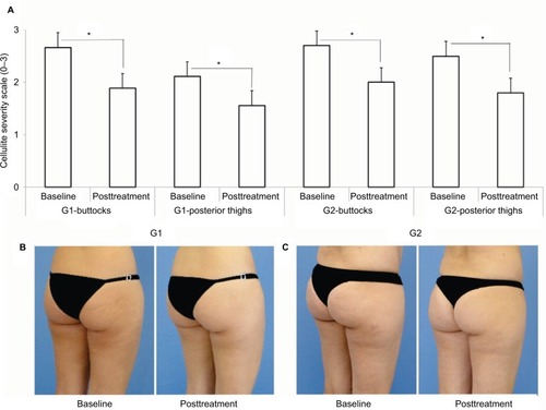 Figure 2 (A) Mean values and SDs of the cellulite degree evaluation according to the generally accepted classification of cellulite at baseline (before) and 15 days after the last session. *Statistically significant difference (P<0.05). Comparative photographic representation showing clinical improvement of the buttocks and posterior thighs in (B) G1 and (C) G2 at baseline and posttreatment.
