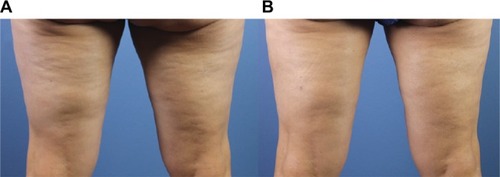 Figure 4 Before (A) and 4 months after (B) laser-assisted subcision of the posterior thighs demonstrating significant improvement in skin contour.