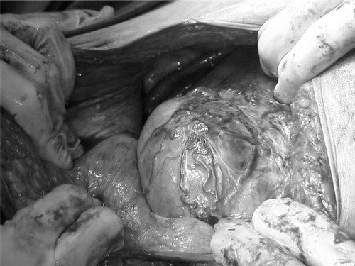 Figure 6 Thin and very vascular uterine lower segment at the time of cesarean section.