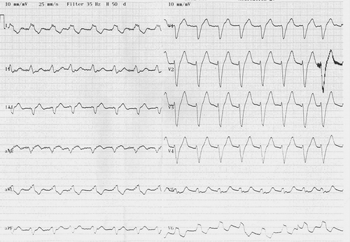 Figure 1. Twelve-lead ECG showing accelerated idioventricular rhythm in a patient with hyperkalemia.
