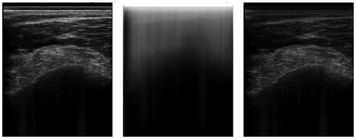 Figure 1. Original ultrasound image (left), the shadow confidence map (Middle) computed by the shadow Peak algorithm, and its multiplication, the masked image (right). Note, that while soft tissue interfaces are damped, the bone surface remains barely discernable.