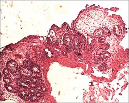 Figure 5.  Colonic mucosal biopsy showing marked crypt architectural distortion, branching and clustering of crypts, intervening widely spaced lamina propria shows edema and inflammation, features reminiscent of idiopathic inflammatory bowel disease, hematoxylin eosin stain, 200×.