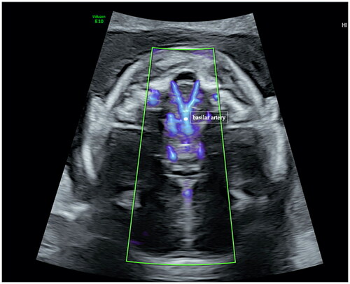 Figure 1. The basilar artery was identified in the oblique axial transabdominal plane at the level of the medulla oblongata in a 21-week, 6-day-old gestational fetus using SlowFlow HD ultrasound.