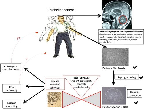 Figure 1. iPSC technology has already started to foster the study of the human cerebellum and its pathologies in a patient-specific way. Overcoming the current bottleneck of directed differentiation will further facilitate the beneficial effects of this technology on the disorders of the cerebellum. Cerebellar Patient taken from Netter's Concise Neurology, p.85, Elsevier, Inc. (copyright).