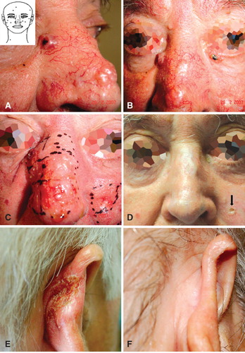 Figure 1. Immunocryosurgery for the treatment of two representative patients with therapeutically challenging BCC disease: treatment course and outcomes. Panels A–D: treatment of a patient with a multitude of concurrent, almost confluent head-and-neck BCCs (Patient 1). (A) Detail of the patient's mid-face showing multiple BCCs covering most of his nose surface. Insert: illustration of the patient's head and neck region indicating the localizations of the concurrent 18 BCCs at presentation. (B) Mid-face of the patient showing multiple, almost confluent BCCs on the nose and concurrent BCCs on the cheeks. (C) The same region as in Panel B on the day of cryosurgery showing heavily inflamed tumors after treatment with daily 5% imiquimod cream for 4 weeks (during the 2 last weeks in combination with 0.1% tazarotene gel) just before the cryosurgery session. (D) The same region as in Panel B 24 months after treatment. The outcome of treatment was excellent, with minimal scarring and sustained remissions in 15/16 tumors treated by immunocryosurgery (one tumor relapsed during the 2-year follow-up: Panel D, arrow). Two BCCs – the tumor at the left lower eyelid (Panel B) and a tumor on the right lower eyelid – were surgically removed prior to the immunocryosurgery. Panels E and F: patient 2. (E) Neglected BCC relapse of the right ear 5 years after excision of the primary tumor at presentation. (F) Clinical outcome 18 months after treatment with a single cycle of immunocryosurgery.