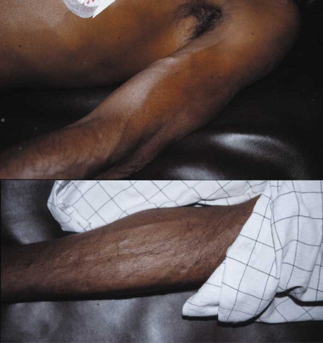 Fig. 1.  Peripheral vasodilatation in patients 1 and 2 while hypotensive on admission. Both photographs were taken when the patients were supine with BPs of 85/35 mmHg (top, case 1) and 55/30 mmHg (bottom, case 2), respectively.