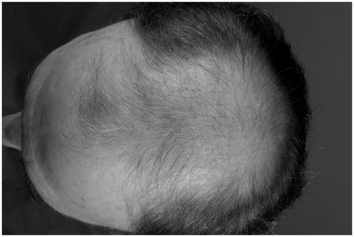 Figure 3. Androgenic alopecia. In an advanced stage, the bald skin of the scalp is surrounded by a chaplet.