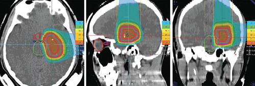 Figure 4. Proton radiotherapy applied with two hirizontal beams for a pediatric low-grade glioma clinically progressive after wait-and-see strategy; a total dose of 54 Gy E protons in single doses of 1.8 Gy E was performed.