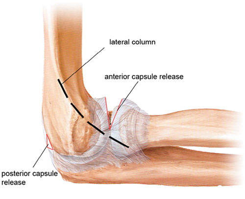 Figure 1. Column procedure with anterior and posterior capsule release.