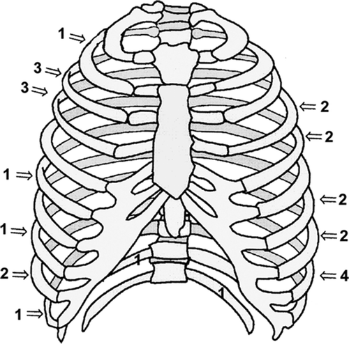Figure 1. Distribution of the 26 different Ewing sarcomas of the rib.