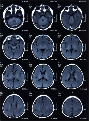 Figure 3. Postoperative head MRI scan (T1).
