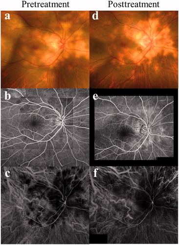 FIGURE 1. Photographs of the right eye at the initial visit (a–c) and 7 months after systemic prednisolone therapy (d–f) in a patient with serpiginous choroiditis. (a) Panorama fundus photograph showing yellow choroiditis plaques with a serpiginous distribution outward from the optic disc. (b) Fluorescein angiography of the venous phase showing initial faint hypofluorescent patches with ill-defined margin within the choroiditis plaques. (c) Indocyanine green angiography (ICGA) of the initial phase showing hypofluorescence corresponding to the plaques. (d) Choroiditis plaques developed serpiginous-shaped scar lesions sparing the macula. (e) Fluorescein angiography revealed hyperfluorescence corresponding to the scar lesions (d). (f) On ICGA, the hypofluorescent areas decreased compared to those at the initial visit (c).