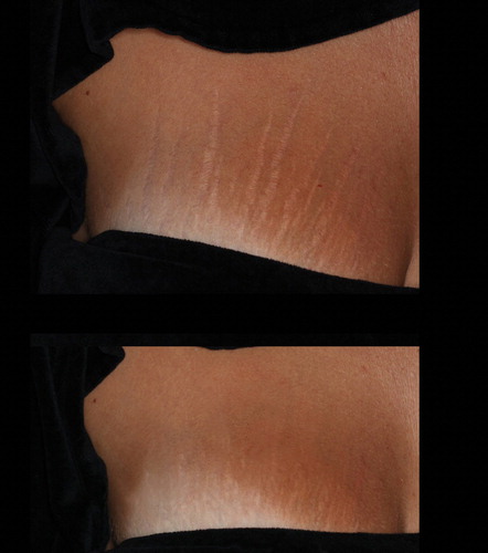 Figure 3. A 28 year-old, ST III female who presented widespread striae alba from pregnancy (an onset of 3 years). The top image was taken before treatment, and the bottom image was taken after 3 treatment sessions, as described in the section, Materials and Methods. Marked improvements in the texture as well as the color of the striae (from IIIb to IIa, according to the Deprez-Adatto scale) can be seen following the treatment, as compared to the baseline.