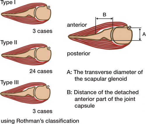 Figure 2. Evaluation of the site of attachment of the joint capsule: The joint capsule is attached to the glenoid labrum, as shown in type 1, in the normal condition. Three types have been described according to the degree of detachment of the joint capsule.