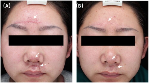 Figure 4. A 28-year-old female with hypertrophic scars from surgery on face at (A) baseline and (B) 3 months after three CO2-IPL treatments showing excellent improvement in thickness, color, stiffness and texture.