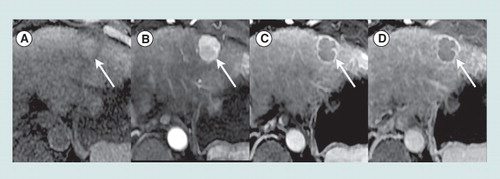 Figure 1. LI-RADS 5: definitely hepatocellular carcinoma.Axial T1-weighted fat-saturated magnetic resonance images obtained precontrast (A) and after injection of an extracellular gadolinium-based contrast agent, in the hepatic arterial (B), portal venous (C) and 5-min delayed (D) phases show a 2.5 cm mass in segment 2 (arrow) of the liver in a 63-year-old woman with cirrhosis due to hepatitis C viral infection. Relative to liver, the mass is mildly hyperintense precontrast, hyperenhances in the arterial phase, and hypoenhances in the portal venous and delayed phases (washout appearances). A peripheral rim of enhancement is evident in the portal venous and delayed phases (capsule appearance). In a patient with cirrhosis or other risk factors for HCC, a mass with these imaging features is categorized LI-RADS 5 (100% certainty observation is HCC).HCC: Hepatocellular carcinoma; LI-RADS: Liver Imaging Reporting and Data System.