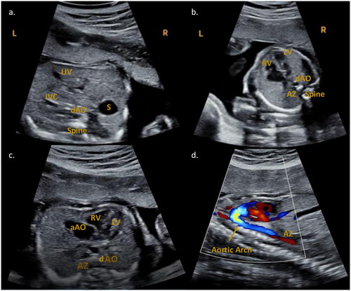 Figure 1. Fetal echocardiography performed at 22w1d. (a) Abdominal situs view. The stomach (S) is localized on the right side of the fetus. In front of and slightly to the left of the spine is the descending aorta (dAO). The umbilical vein (UV) and the inferior vena cava (IVC) are present anteriorly and to the left. (b) Four chamber view. The dAO and the azygos vein (AZ, further to the left) are anterior to the spine. RV: right ventricle; LV: left ventricle. (c) Transverse view. RV: right ventricle; LV: left ventricle; aAO: ascending aorta. The dAO and the AZ (to the left) are anterior to the spine. (d) Sagittal aortic arch and azygos vein view. Inferior to the flow of the aortic arch a red flow is visible, attributable to the azygos continuation of the inferior vena cava.