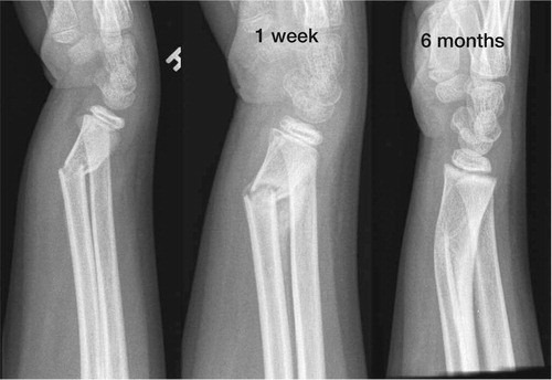 Figure 6. Remodelling of a displaced complete fracture of the distal radius in a 7 year old girl.