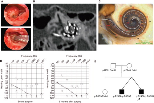 Figure 2. Case no. 17. (A) Endoscopic view of round window insertion, (B) montage CT image, (C) imaging with putative location of electrode and the referential tonotoic map, (D) preoperative and postoperative audiograms. (E) Pedigree and the mutations found in the CDH23 gene.