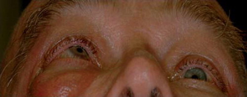 Figure 8. A patient with thyroid eye disease exhibiting prominent exophthalmos that is greater in the right eye with significant restriction of right eye movement.