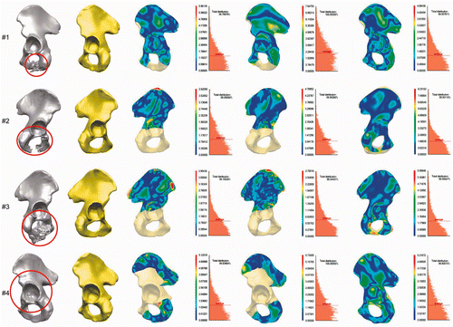 Figure 2. Application and evaluation of the SSM-based pelvic reconstruction approach in clinical cases. First column: Location of the defects (tumors) in the segmented CT data, marked with red circles. Second column: Reconstructed hemipelvis surface (shown in yellow). Third column: Color-coded map of the distances between the original and the reconstructed pelvic surfaces. The uncolored portion is the reconstructed defect area (after virtual wide resection of the bone tumor). Fourth column: Distribution of the distances between the original and the reconstructed (SSM-based) pelvic surfaces in the intact areas, and the average distance (red dotted line). Fifth column: Map of distances between the original and the mirroring-based reconstructed pelvic surfaces (in intact areas). Sixth column: Distribution of the distances for the reconstruction method in the preceding column. Seventh column: Distance maps for the SSM-based reconstruction of the equivalent osteotomy performed in the contralateral healthy hemipelvis (for the whole hemipelvis). The contralateral healthy hemipelvis acts as the ground truth in this part of the evaluation. Eighth column: Distribution of the distances for the reconstruction method in the preceding column.