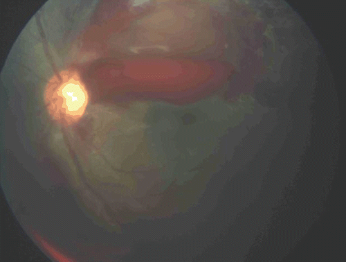 FIGURE 2  Color fundus photograph of the left eye showing large preretinal hemorrhage temporal to disc involving the macula.