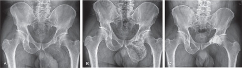 Figure 1. A. A well-defined 11 × 9 × 8 cm expansile osteolytic lesion extending from the left ischium to the lower arm of the left pubis in a 52-year-old man with progressive pain in his left hip and leg. Radiographic findings were consistent with the diagnosis of GCTB. B. 3 months after the start of denosumab treatment, there was no progression of disease and increased radiopacity of the lesion. C. 5 years after resection of the ischium and inferior ramus of the pubis followed by phenolization and cementation of the posterior acetabular wall, there was no evidence of recurrent disease.
