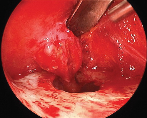 Figure 2. Following adhesiolysis and a circumferential osteotomy in a box-like fashion, the infraorbital nerve is successfully released from previous entrapment.