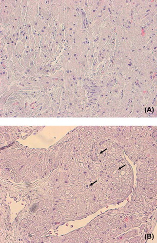 Figure 1. Representative histology of right atrium before (A) and during (B) coronary artery bypass grafting (CABG). Note increased vacuolized and dark sharp-edged intramyocardial nuclei indicating tissue edema and ischemia shown with arrows in B.