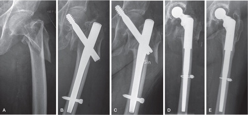 A subtrochanteric fracture treated with internal fixation (A and B). Due to migration of the screw into the pelvis (C), a THA was performed 1.5 months after the first operation (D). 1 year after the index operation, the subtrochanteric fracture appeared to have healed without any major subsidence of the stem (E).