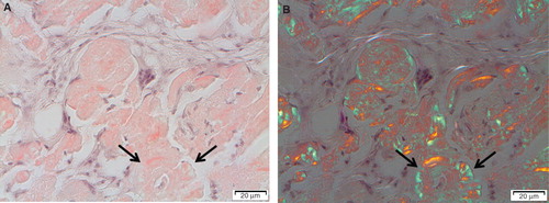 Figure 2. Typical appearance of localized AL amyloidosis with discrete amyloid formation and multiple giant cells. Note the concentric appearance of some amyloid particles (arrows).