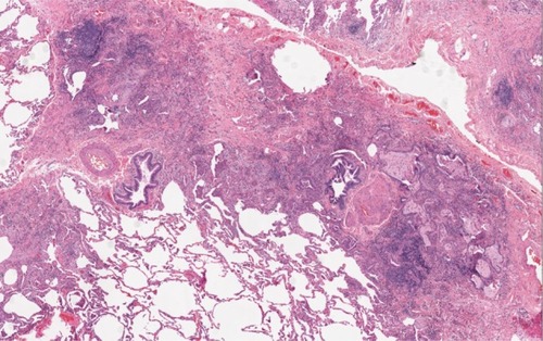 Figure 4 Histopathology in a patient with RA-ILD associated UIP. A surgical biopsy specimen in a patient with RA showing patchy interstitial fibrosis that starts in the peripheral acinar regions and is in close proximity to unaffected lung tissue.