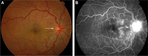 Figure 7 Color retinal photograph of the right eye showing swollen and hyperemic optic discs (A) and FFA showing hot disc (B) (white arrows), in the acute phase of VKHD.