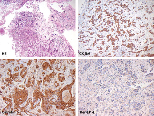 Figure 3. Malignant peritoneal mesothelioma, epitheloid variant. Tumor architecture is partially papillary, partially tubular with solid components (H&E). Positive staining for CK5/6 and Calretinin. Negative staining for Ber-EP4. Low proliferation rate (MIB-1 staining not shown).