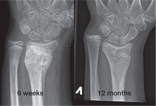 Figure 7. Growth arrest of the distal radial physis following a SH Type 2 fracture in a 12 year-old girl that was initially reduced on the day of injury, and re-manipulated 3 days later due to loss of reduction.