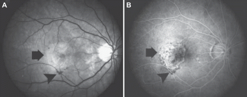 Figure 5. Wet form of age-related macular degeneration with oedema, CNV (arrows), and haemorrhages (arrowheads). A: Fundus photograph. B: Fluorescein angiography image in the 30 s time point.