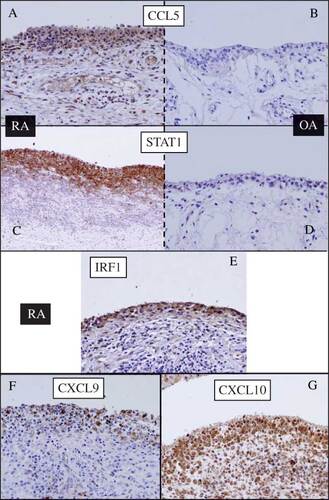 Figure 5. Immunohistochemical staining of the synovium from (A, C, E, F, and G) RA and (B and D) OA patients. (A and B) anti-CCL5; (C and D) anti-STAT1; (E) anti-IRF1; (F) anti-CXCL9; (G) anti-CXCL10. Significant presence of all antigens was detected in the synovial lining cells of RA but not of OA.
