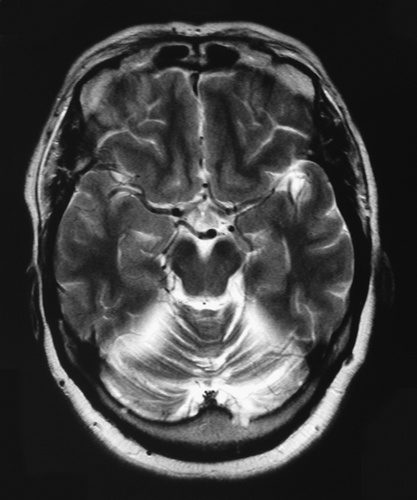 Figure 3.  T2-weighted axial MRI-brain. CSF lies within the folia of the cerebellum secondary to parenchymal cerebellar loss.