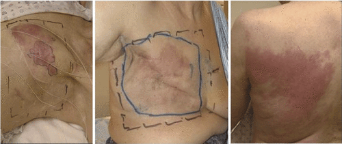 Figure 1. Typical cases of chest wall recurrence of breast cancer to be addressed with conformal thermotherapy.