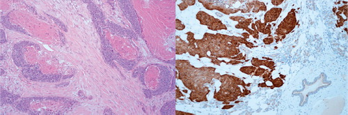 Figure 2. Biopsy of one of the tumors: left HE staining, right p16 staining