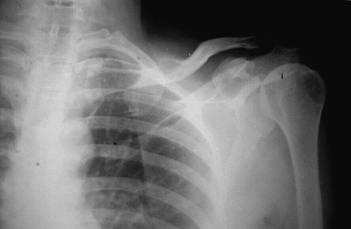 Figure 1.  The radiograph demonstrates an ill defined lytic lesion involving medial two thirds of the clavicle with a soft tissue shadow extending beyond the confines of the bone.