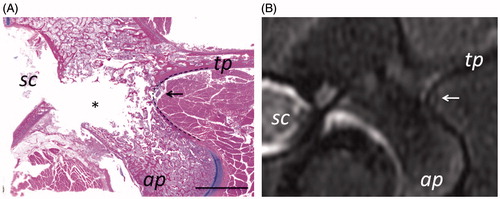 Figure 3. MB nerve in Yorkshire swine was found to pass adjacent to the bone at the junction of the transverse and articular processes (labelled tp and ap). On histology (A), the nerve is seen surrounded by a layer adipose tissue (arrow). Scale bar is 1 cm. On MRI (B), a small hyper-intense region surrounded by a hypo-intense rim (arrow) corresponds to the position of the nerve determined from histology. Location of spinal cord is labelled as sc.