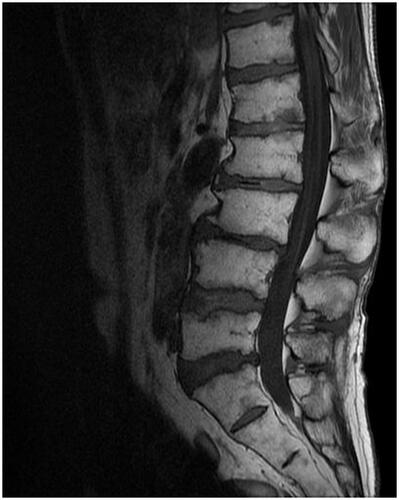 Figure 3. MRI T1 (18 January, X + 1) weighted image shows the patient’s lumbar spine turned into fatty bone marrow.